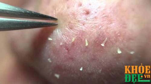 nan mun sai cach khong tiet trung dung cu