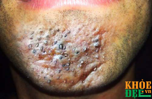 nan mun sai cach mun dinh rau