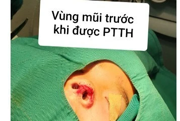 Lục thùng rác tìm mảnh cánh mũi bị đứt rời tới viện để ghép cho bé 5 tuổi