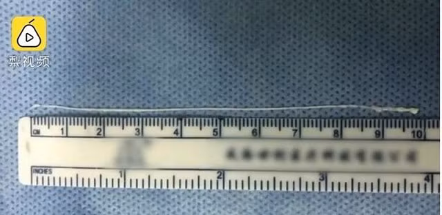 Phát hiện sán dài 10cm, sống khỏe trong não bệnh nhân - Hình 2