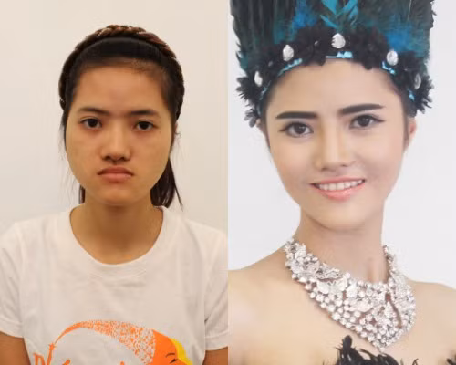 Hoàng Hiên trước và sau khi phẫu thuật thẩm mỹ