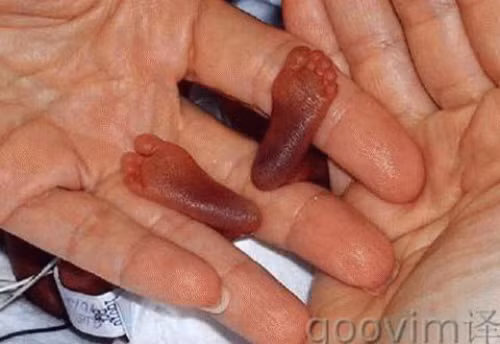 Bé sơ sinh nhỏ nhất thế giới với cân nặng chưa đầy 300 gram và 24 tuần tuổi. nhung-thu-nho-nhat-tren-the-gioi-4