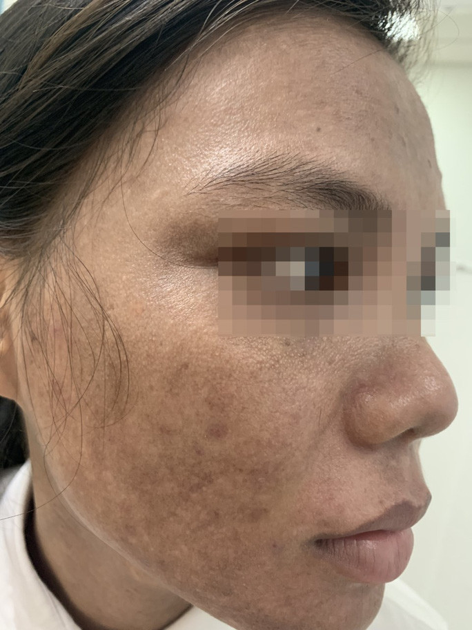 Kem trộn rao trên mạng tàn phá dung nhan một cô gái - Ảnh 1. Kem trộn rao trên mạng tàn phá dung nhan một cô gái - Ảnh 1.