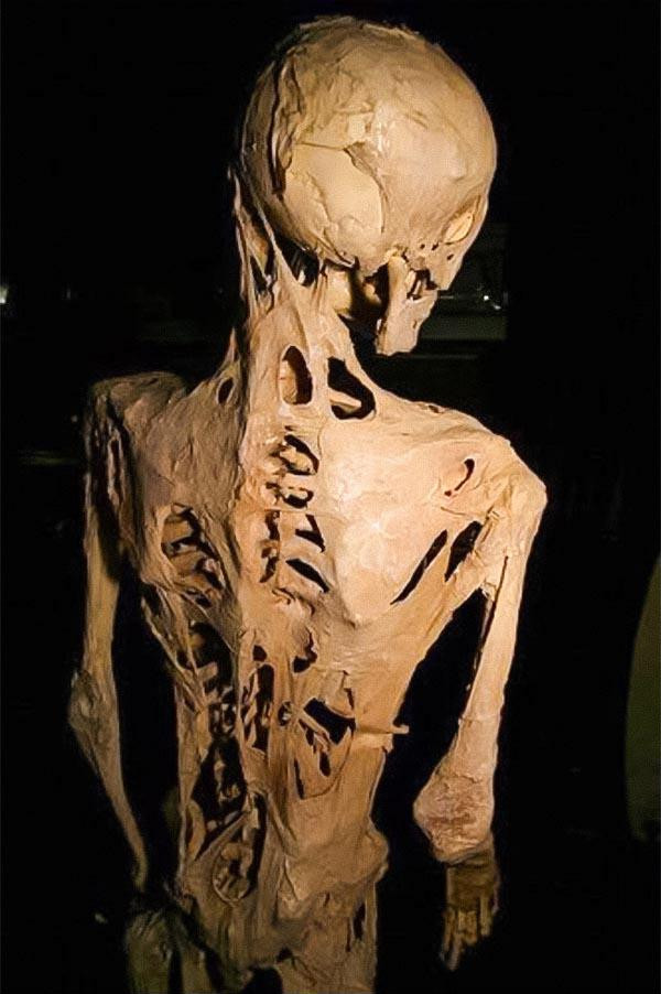 Những căn bệnh lạ mới nghe tên thôi đã “rùng cả mình” ảnh 4 Những căn bệnh lạ mới nghe tên thôi đã “rùng cả mình” ảnh 4