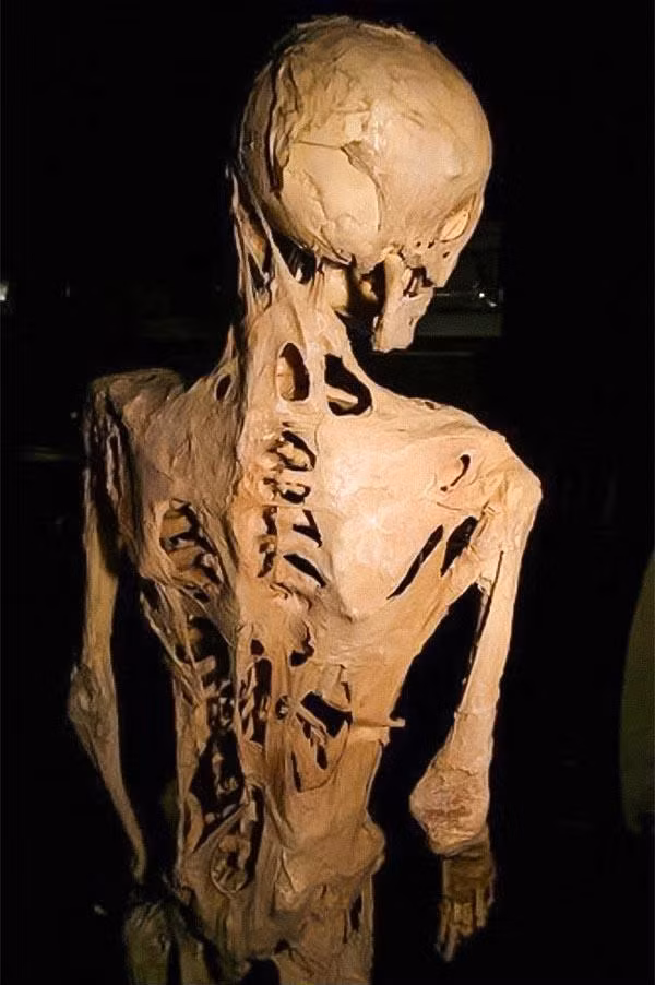 Những căn bệnh lạ mới nghe tên thôi đã “rùng cả mình” ảnh 4