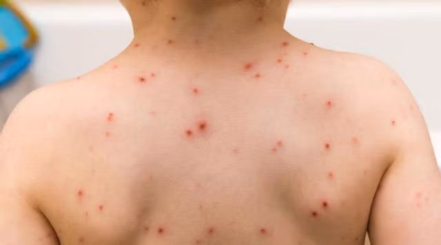 Bệnh thủy đậu cũng là một dạng vũ khí sinh học.