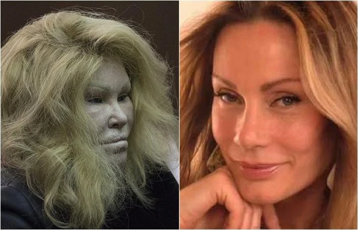 Khuôn mặt của bà Jocelyn Wildenstein hồi trẻ (phải) và sau khi trải qua hàng loạt cuộc phẫu thuật. Ảnh: Daily Mail.