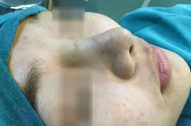 Mũi cô gái xuất hiện các đốm tím, co rút và biến dạng. Mũi cô gái có đốm tím, bác sĩ tá hỏa gắp ra cả bó chỉ - ảnh 1