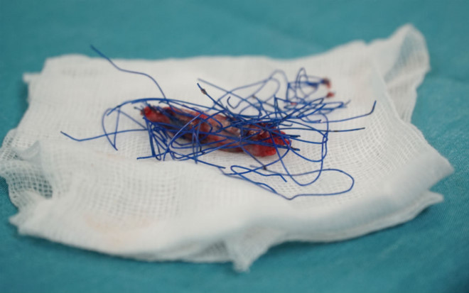 Bác sĩ tá hỏa khi lấy ra cả bó chỉ từ mũi cô gái trẻ. Mũi cô gái có đốm tím, bác sĩ tá hỏa gắp ra cả bó chỉ - ảnh 2