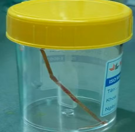 Chiếc tăm dị vật được lấy ra từ ổ bụng bệnh nhân