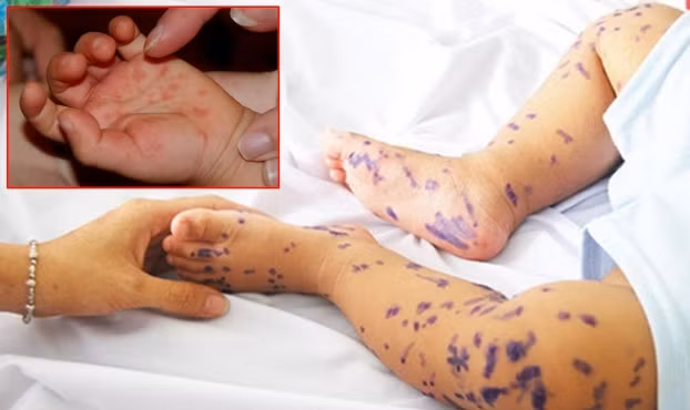 TP HCM: Trường hợp tử vong đầu tiên vì tay chân miệng có biểu hiện thế nào?