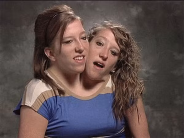 Song sinh dinh lien 1