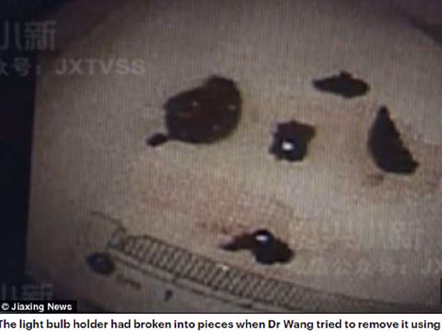 Hút thuốc nuốt luôn chuôi bóng đèn vào phổi, hơn 30 năm sau mới biết - Hình 1