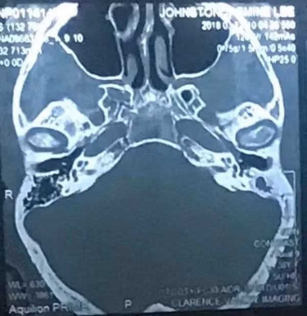 Cảnh báo: Dùng tăm bông lấy ráy tai, người phụ nữ suýt bị nhiễm trùng não và có nguy cơ tử vong-2