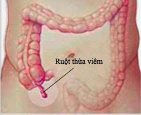 Dấu hiệu viêm ruột thừa?