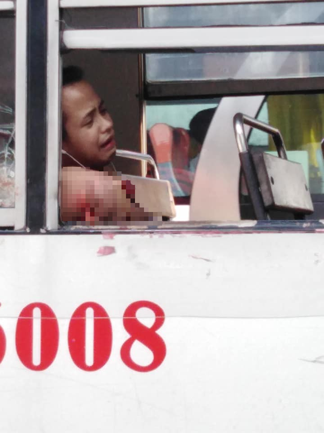 Thanh niên đau đớn mất cánh tay chỉ vì thói quen nhiều người mắc phải khi đi xe buýt ảnh 1 Thanh niên đau đớn mất cánh tay chỉ vì thói quen nhiều người mắc phải khi đi xe buýt ảnh 1
