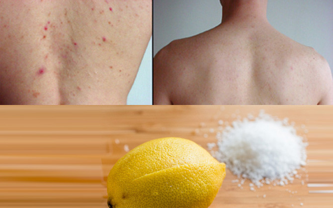 Cách trị mụn trứng cá ở lưng, ngực đơn giản và hiệu quả nhất Cách trị mụn trứng cá ở lưng, ngực đơn giản và hiệu quả nhất