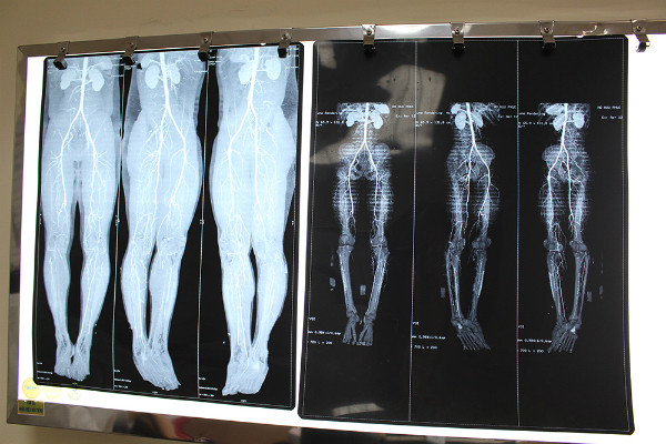 Ảnh chụp phim tắc động mạch chi dưới của bệnh nhân.