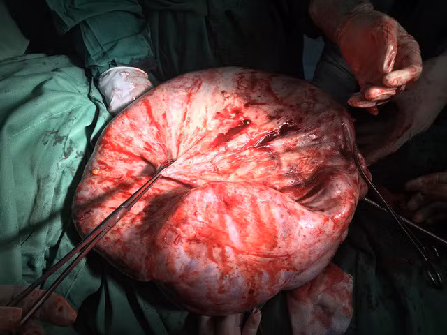 Khối u khổng lồ nặng tới 17kg được bác sĩ bóc tách lấy ra ngoài thành công