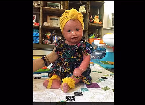 Cô bé vảy cá mỗi ngày mất 4 giờ để… tắm