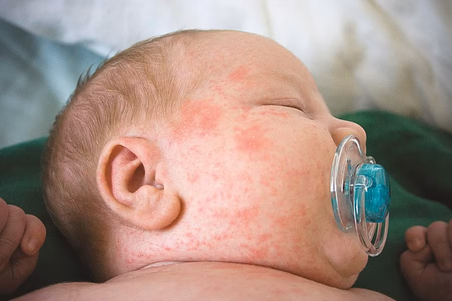 Hà Nội: Nguy cơ lây lan và bùng phát dịch sởi, sốt xuất huyết vẫn rất lớn