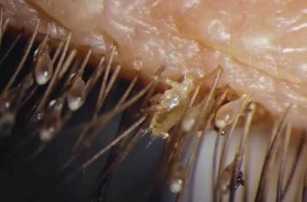 Kinh hoàng ổ chấy rận ký sinh trên hàng mi giả ảnh 4 con ai muon noi mi gia khi nhin thay o chay ran ky sinh tren noi "dang song" nay? - 6