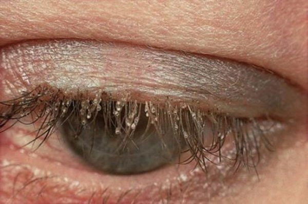 Kinh hoàng ổ chấy rận ký sinh trên hàng mi giả ảnh 3 con ai muon noi mi gia khi nhin thay o chay ran ky sinh tren noi "dang song" nay? - 5