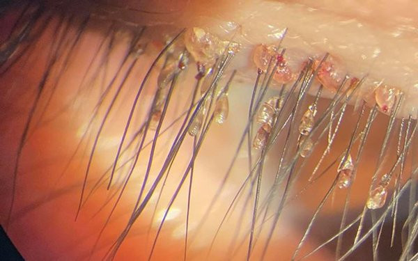 Kinh hoàng ổ chấy rận ký sinh trên hàng mi giả ảnh 7 con ai muon noi mi gia khi nhin thay o chay ran ky sinh tren noi "dang song" nay? - 9