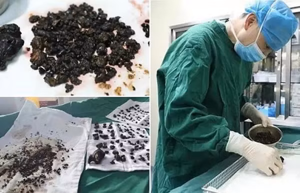 Hai trăm viên sỏi nằm tại gan và túi mật đã được lấy ra thành công.