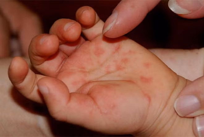 Bệnh tay chân miệng nguy hiểm đối với trẻ và hiện chưa có vắc xin điều trị. 