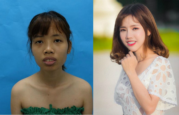 Oanh trước và sau khi phẫu thuật thẩm mỹ. Ảnh: T.H