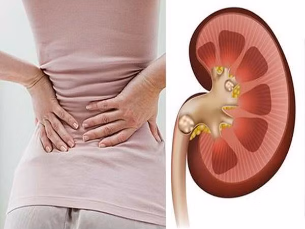  Đau lưng dấu hiệu của sỏi thận 