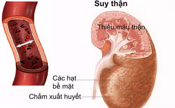 Bé gái 12 tuổi bị suy thận cấp vì uống sản phẩm này thay nước