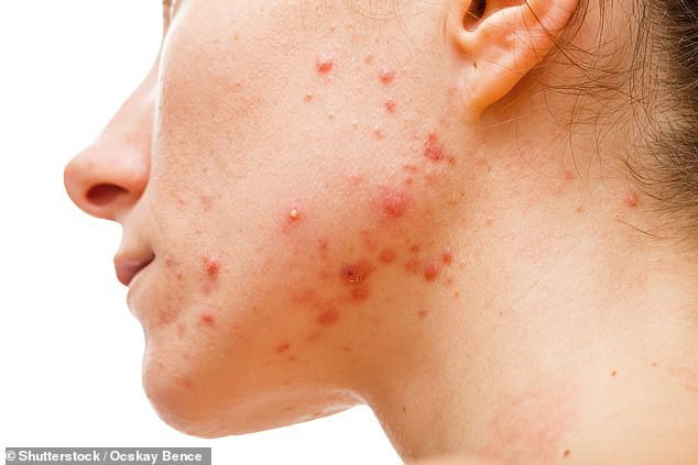 Những dấu hiệu “lạ” mà cơ thể đang cố nói với bạn ảnh 2 Khi bị mụn trứng cá, cơ thể đang cố gắng cảnh báo về rối loạn nội tiết hoặc rối loạn tiêu hóa.