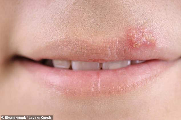 Những dấu hiệu “lạ” mà cơ thể đang cố nói với bạn ảnh 5 Mụn trên môi là một biểu hiện của một nhiễm vi-rút thể ẩn có thể bùng phát khi hệ thống miễn dịch bị tổn hại