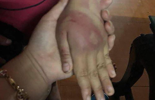 Không chỉ vùng mông, trên mặt và tay bé gái cũng đầy lằn roi. Ảnh: Lam Sơn. Không chỉ vùng mông, trên mặt và tay bé gái cũng đầy lằn roi. Ảnh: Lam Sơn.