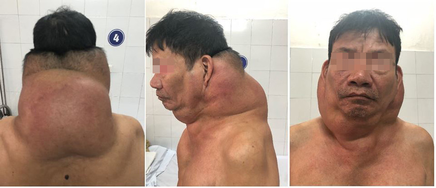 Người đàn ông ở Hải Phòng có chiếc cổ kì dị do nghiện rượu