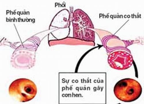 Phòng ngừa hen phế quản tái phát lúc giao mùa