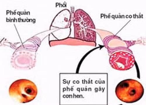 Phòng ngừa hen phế quản tái phát lúc giao mùa