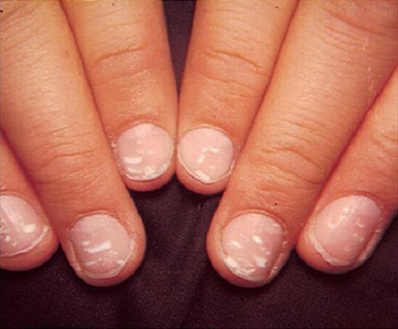 {title} đốm trắng,móng tay,bàn tay