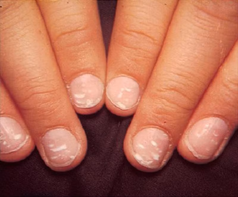 đốm trắng,móng tay,bàn tay