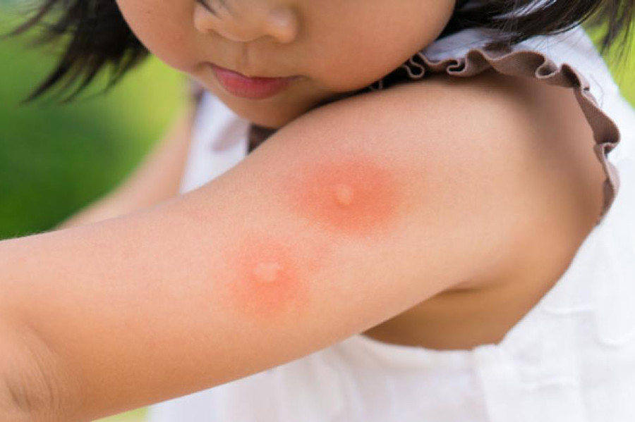 Gần đây, sốt xuất huyết trở nên nguy hiểm hơn do một số người bệnh không có triệu chứng điển hình. (Ảnh: ITN). Gần đây, sốt xuất huyết trở nên nguy hiểm hơn do một số người bệnh không có triệu chứng điển hình. (Ảnh: ITN).