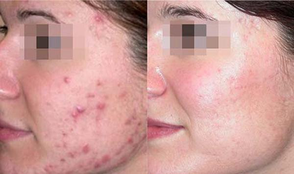 Dùng rau diếp cá làm theo cách này, mụn cứng đầu đến đâu cũng hết sạch ảnh 4 chay ra cho mua rau diep ca ve lam theo cach nay, mun cung dau den dau cung het sach - 4