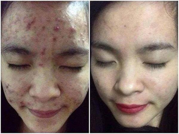 Dùng rau diếp cá làm theo cách này, mụn cứng đầu đến đâu cũng hết sạch ảnh 8 chay ra cho mua rau diep ca ve lam theo cach nay, mun cung dau den dau cung het sach - 8