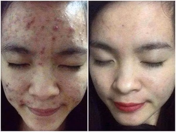 chay ra cho mua rau diep ca ve lam theo cach nay, mun cung dau den dau cung het sach - 8