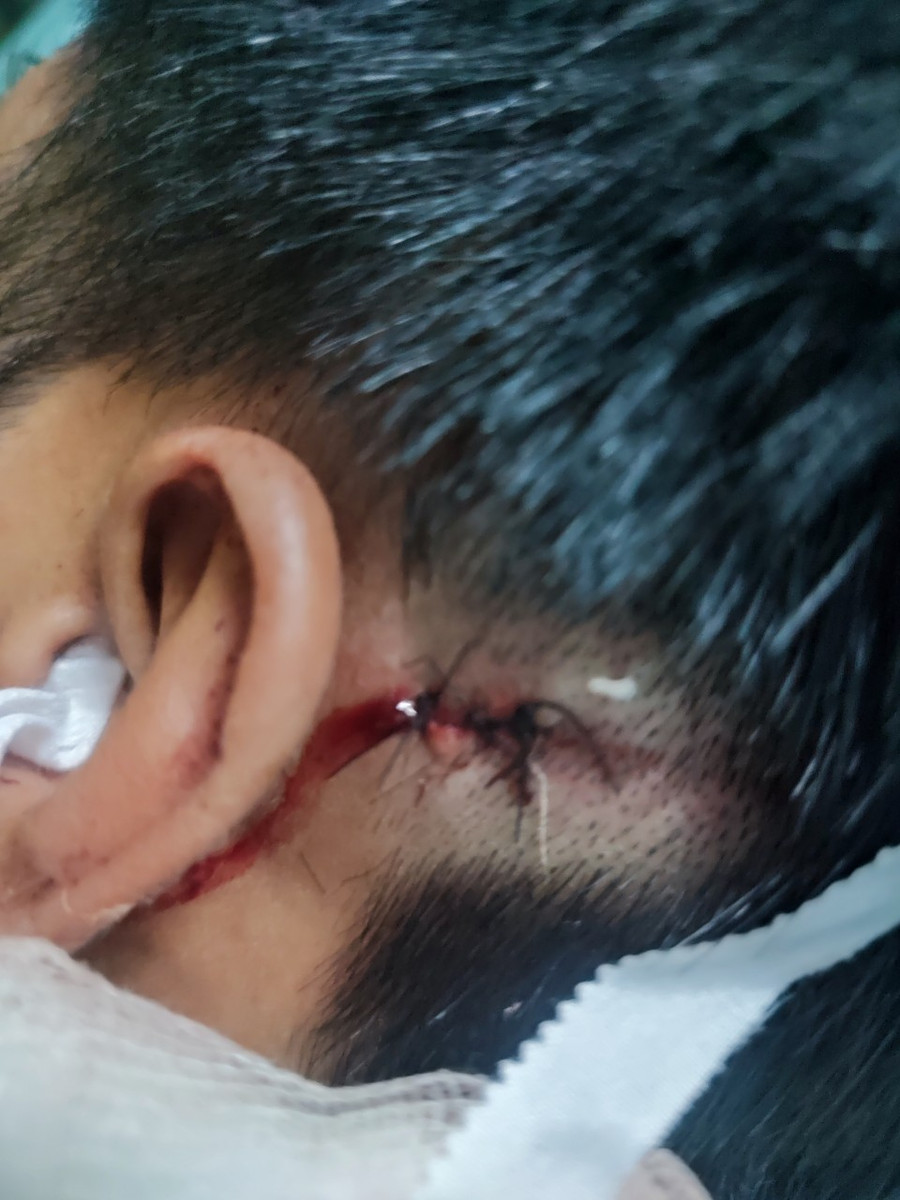 Phần đầu gần lỗ tai anh Nghĩa khâu 3 mũi sau vụ việc.