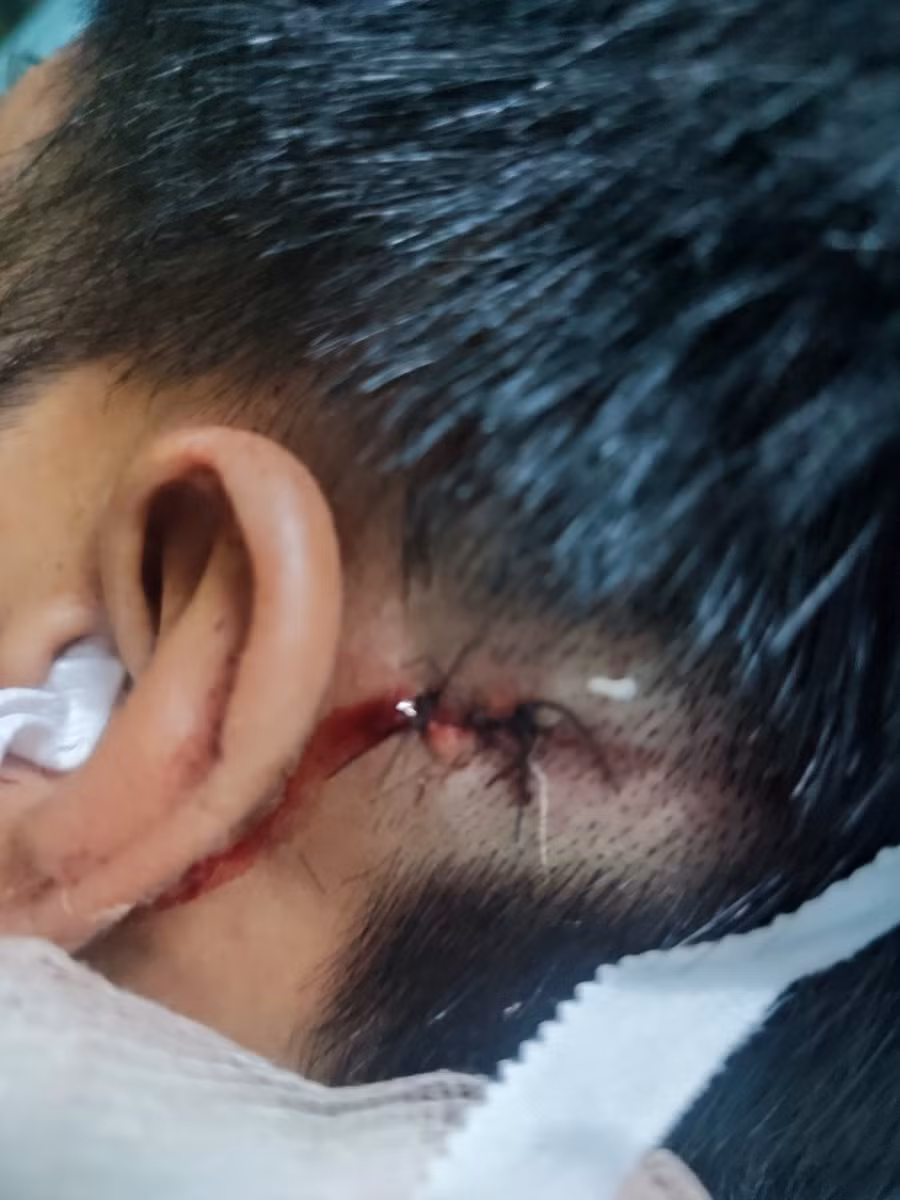 Phần đầu gần lỗ tai anh Nghĩa khâu 3 mũi sau vụ việc.