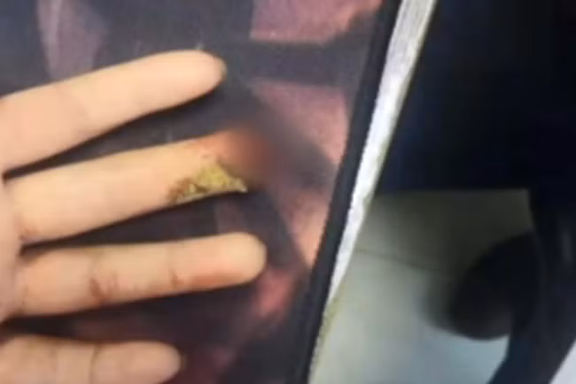 Bé gái 9 tuổi phải cưa ngón tay vì cách sơ cứu sai lầm của bà nội sau khi bị kẹt tay vào cửa-2