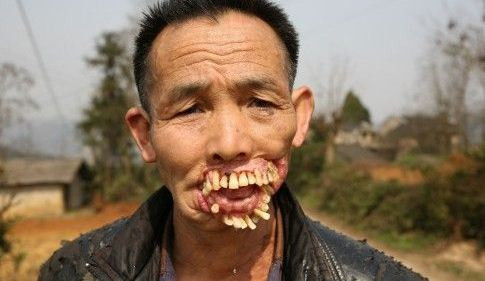 Người đàn ông có “gương mặt quỷ” vì bị chó sói liếm miệng