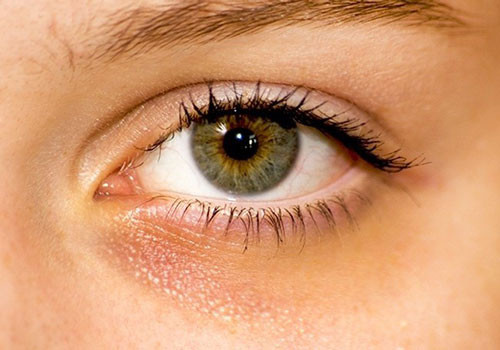 Quầng thâm dưới mắt: Nếu bạn không ngủ đủ giấc, quầng thâm dưới mắt sẽ xuất hiện. Theo Medical News Today, các bác sĩ khuyên mỗi đêm bạn nên ngủ không ít hơn 7-8 giờ. Tuy nhiên, quầng thâm dưới mắt cũng là dấu hiệu của bệnh thiếu máu. Khi đó, cơ thể không sản xuất đủ tế bào hồng cầu, vùng da dưới mắt sẽ bị thâm quầng.